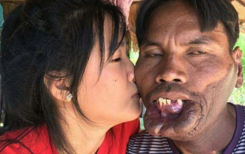 Thai lady who married older man with facial deformity pecks him in new photo